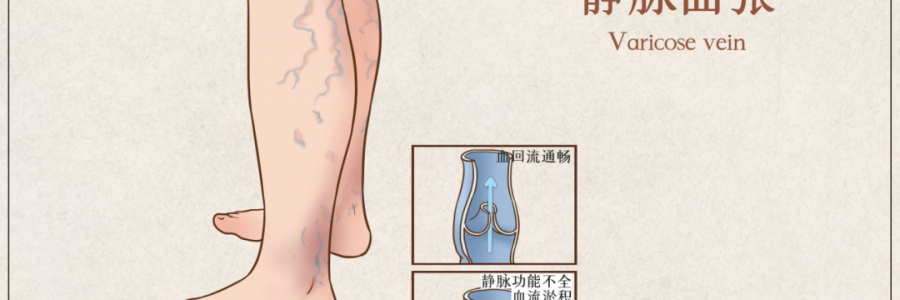 告別“蚯蚓腿”，靜脈曲張?jiān)趺凑{(diào)？