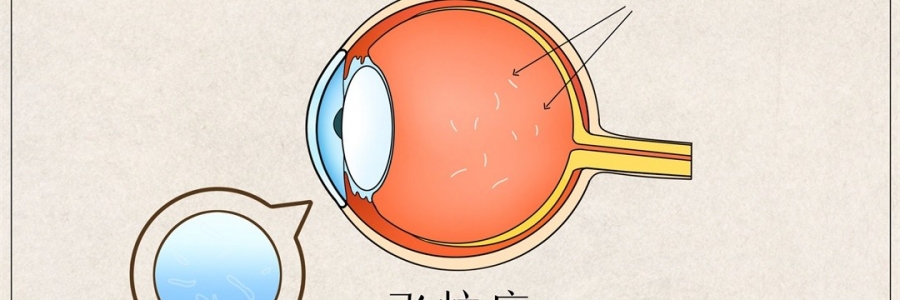 “蚊子”在眼里飛？這類人要注意了！
