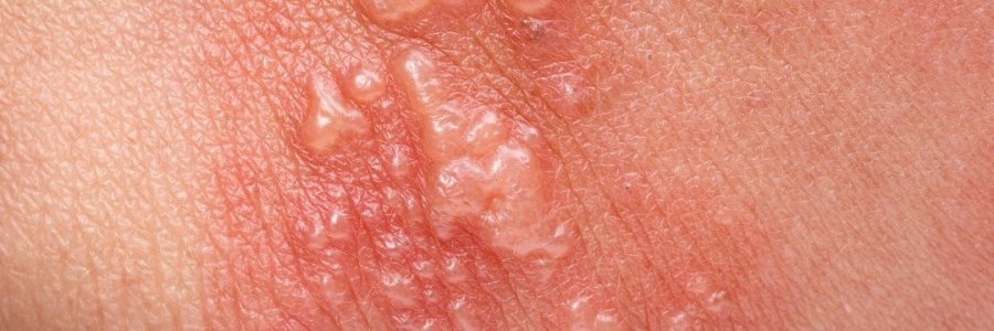 艾灸后起了小水泡，居然是邪氣在“逃跑”！