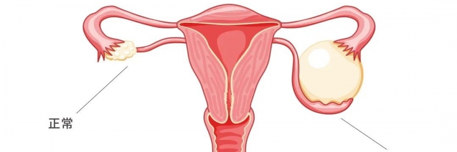 太神奇了，艾灸調(diào)好了她的卵巢囊腫！